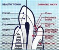 HEALTHY TOOTH DAMAGED TOOTH ENAMEL DENTINE PULP GINGIVA SULCUS ROOT PLAGUE PERIODONTAL POCKET RECEDING GUM BACTERIAL AND FOOD DEBRIS EXPOSED DENTINE BONE LOSS